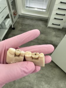 Ruka v rukavici drží dentální modely s dutinami v zubní ordinaci a předvádí tak složitosti stomatologie.