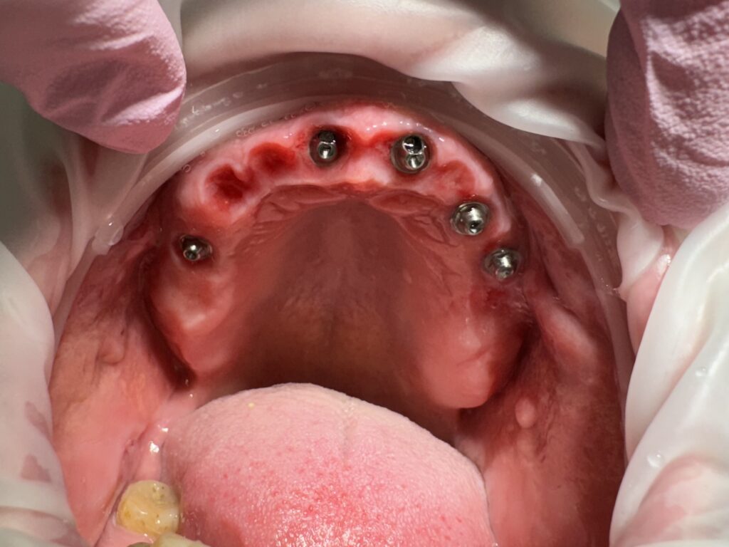 Detailní záběr horní části úst zobrazující zubní implantáty s růžovými dásněmi a viditelným jazykem, odrážející přesnost typickou pro kolínskou zubní ordinaci.