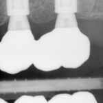 Zubní rentgen se dvěma zubními implantáty a korunkami ze zubní ordinace v Kolíně.