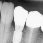 Rentgen tří zubů s viditelným zubním implantátem uprostřed, zvýrazňující pokročilé stomatologické techniky dostupné na naší zubní ordinaci v Kolíně.