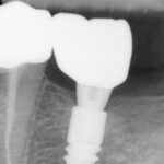 Stomatologie RTG odhalující zubní implantát s korunkou v dolní čelisti.